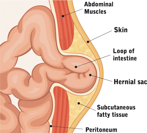 Umbilical Hernia: Definition, Symptoms, Treatment
